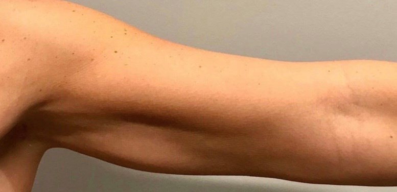 Orland Park Cool Sculpt arms After