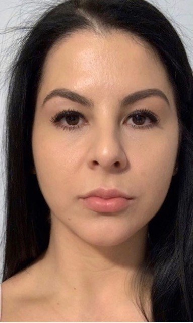 Female Facial Rejuvenation After