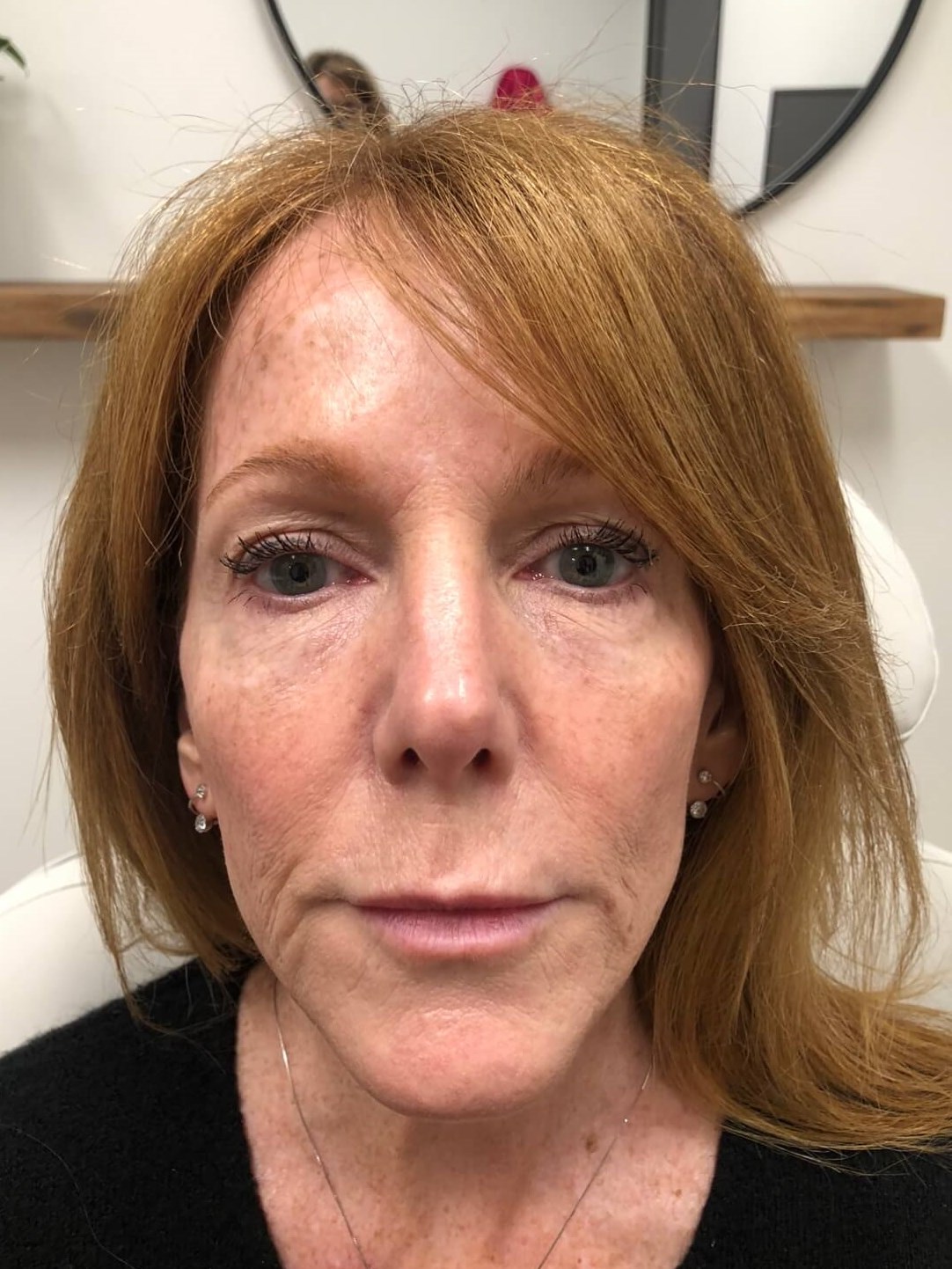 Nonsurgical Face Rejuvenation Before