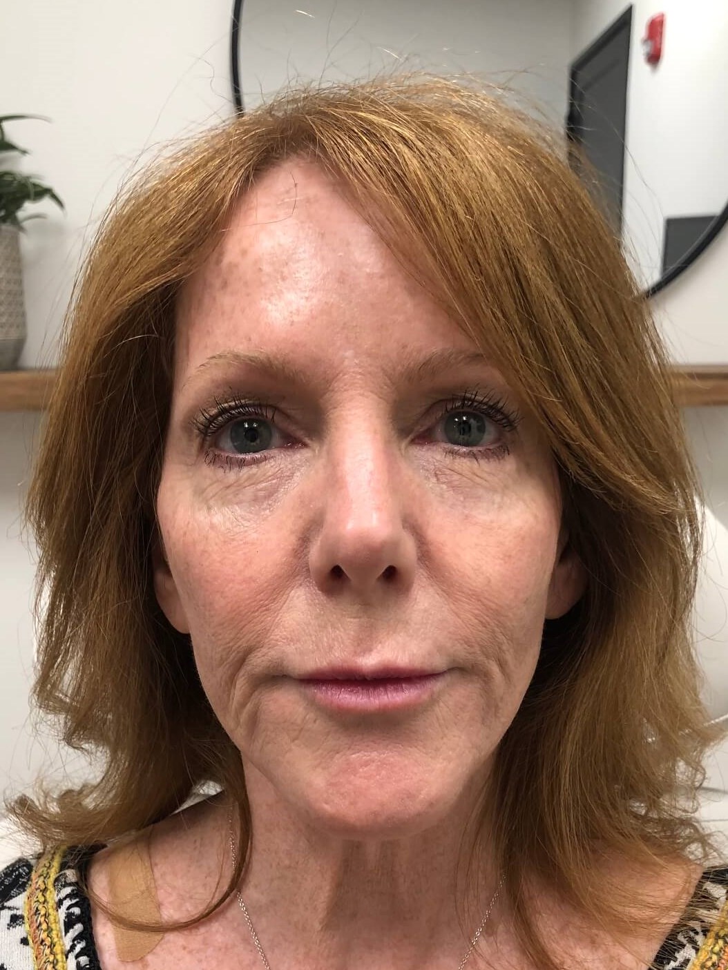 Nonsurgical Face Rejuvenation After