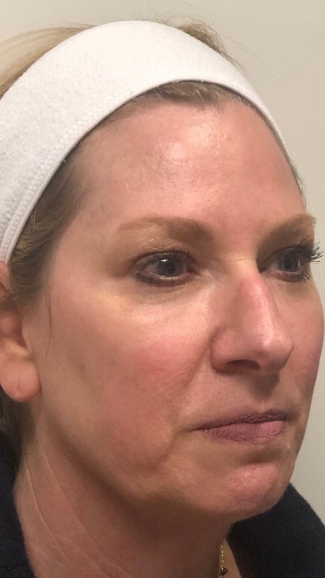 PDO Thread Face Lift Before