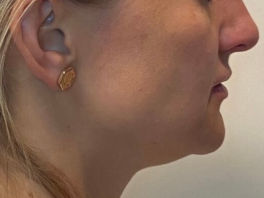 PDO Thread lift & tightening Before