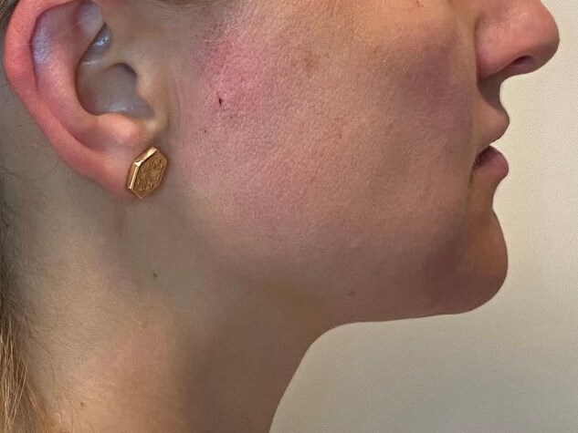 PDO Thread lift & tightening After