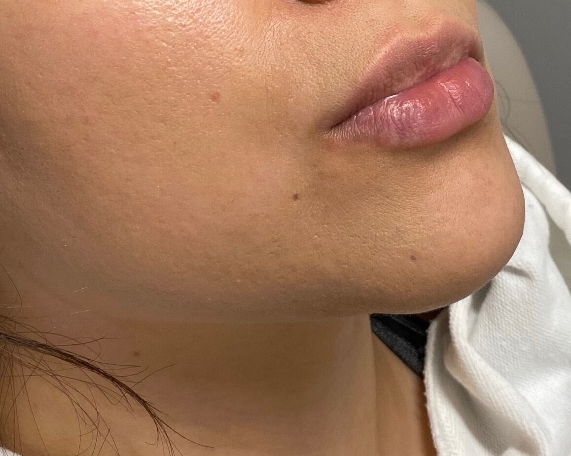 Juvederm lip enhancement Before