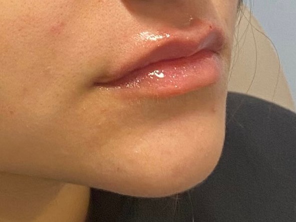Juvederm Volbella Lip filler After