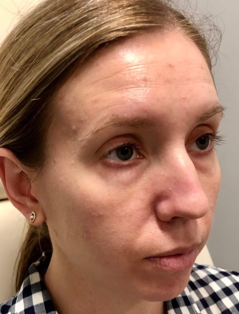 Female Facial Rejuvenation Before