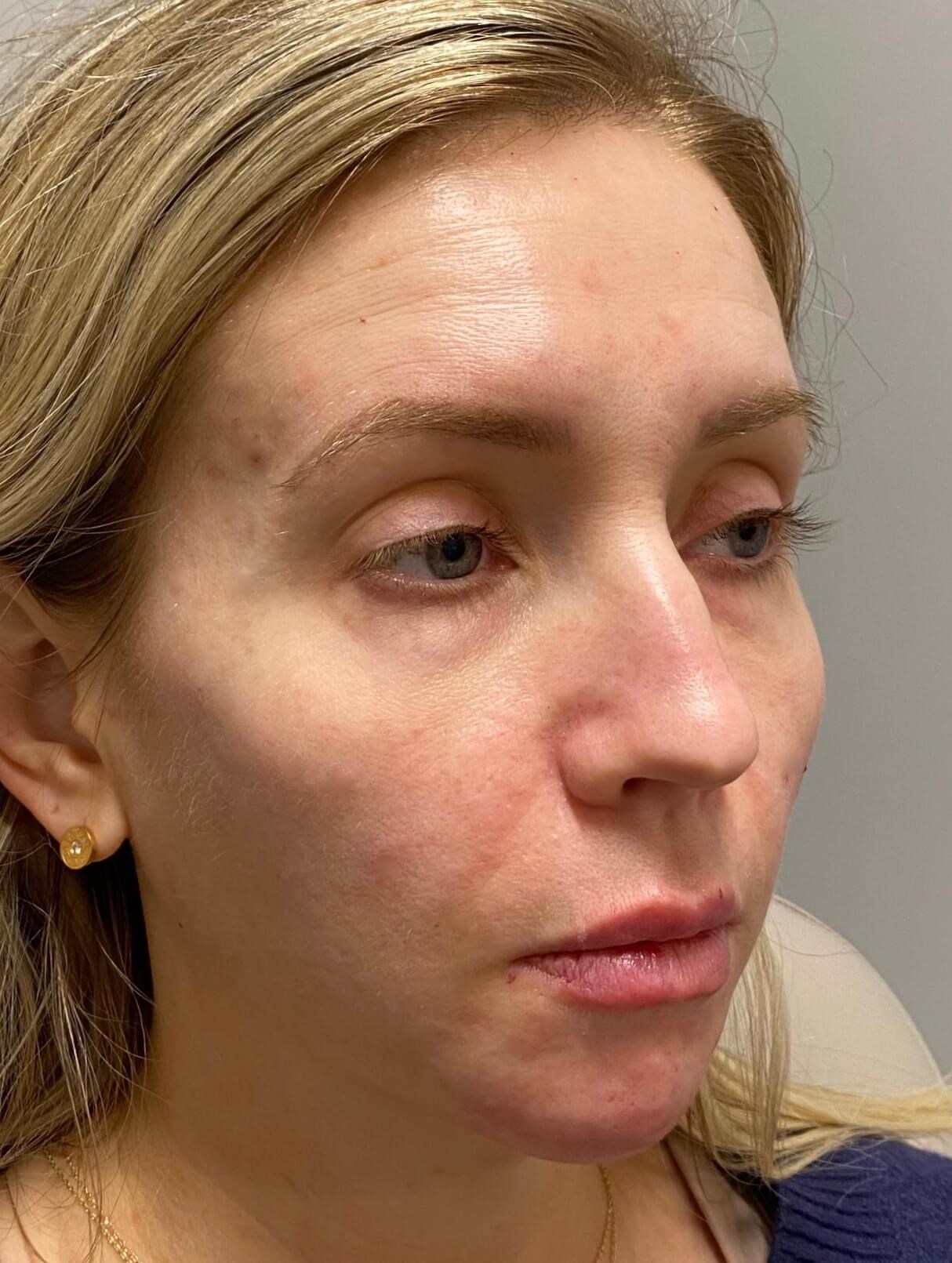 Female Facial Rejuvenation After