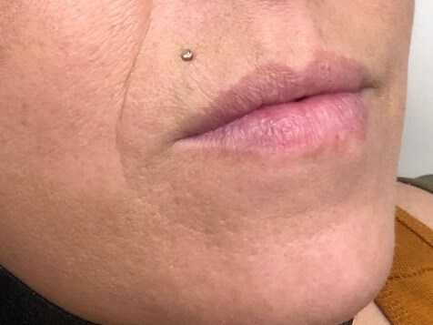 Juvederm lip enhancement Before