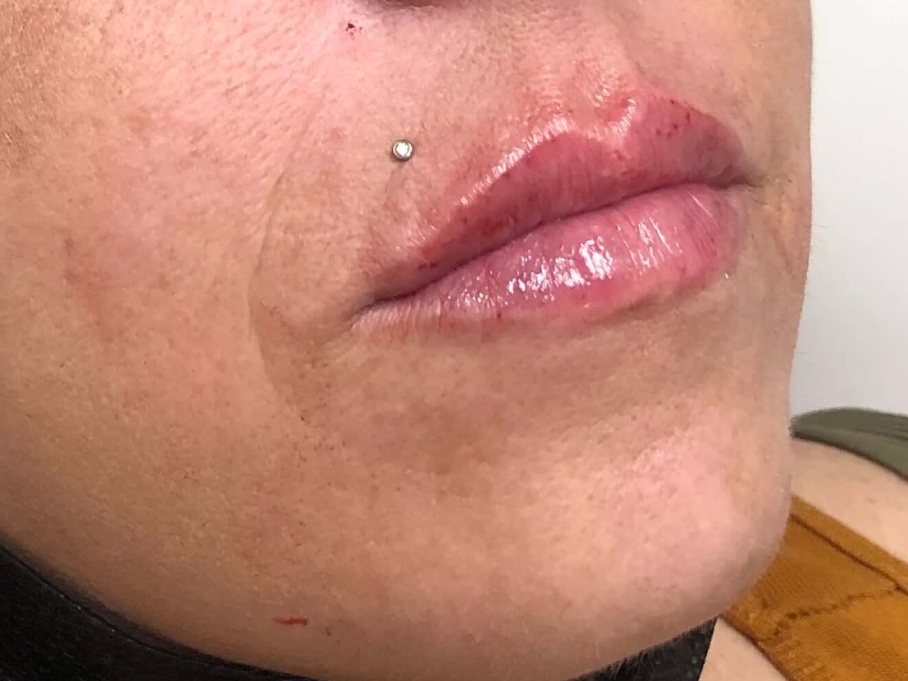 Juvederm lip enhancement After