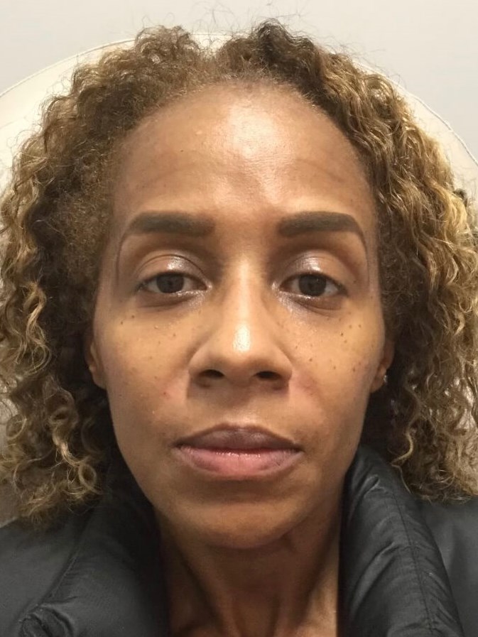 Juvederm Facial rejuvenation After
