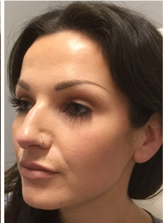 Juvederm Cheeks & Lips After