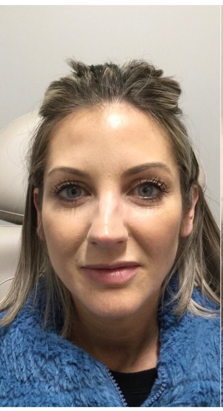 Juvederm Facial enhancement Before