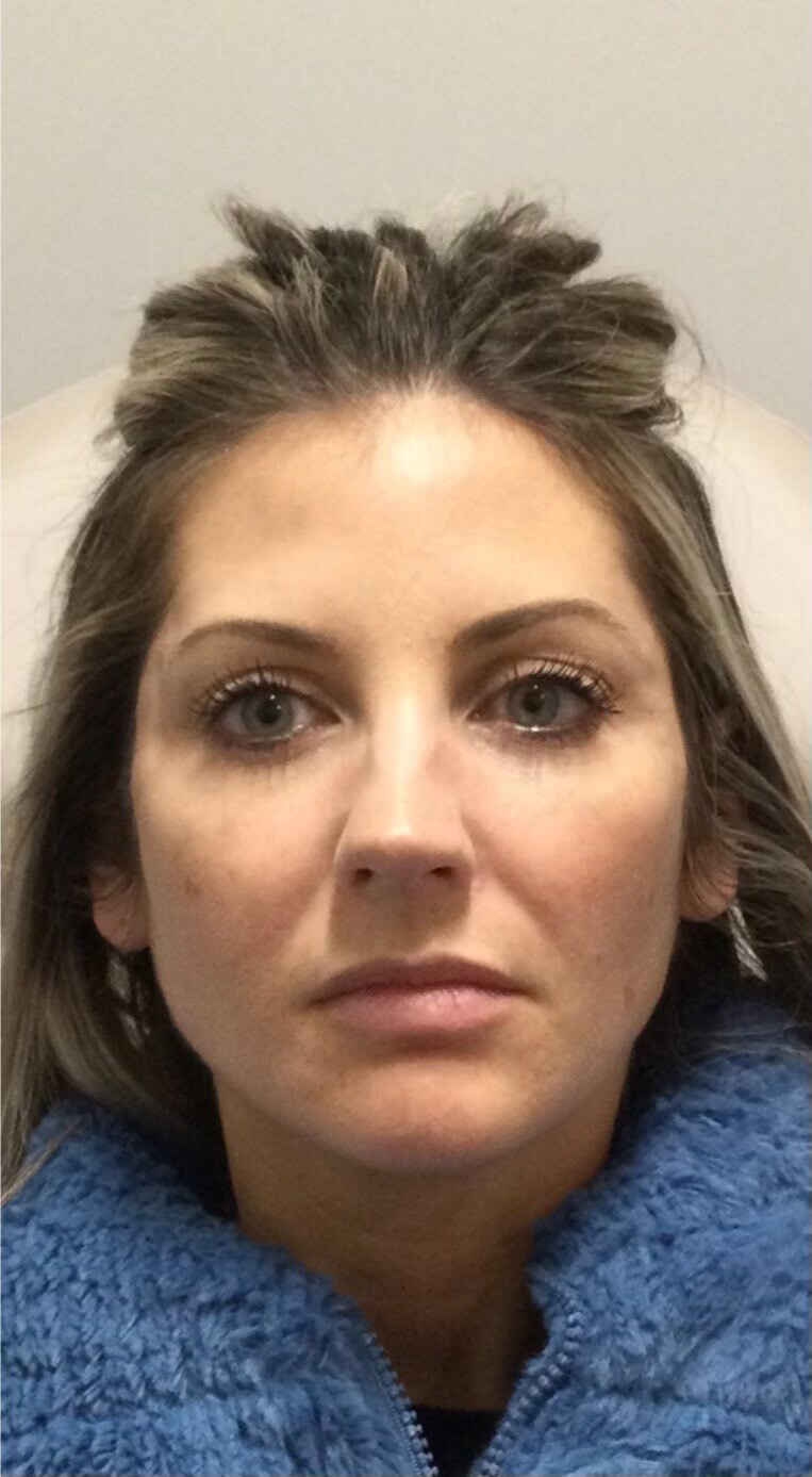 Juvederm Facial enhancement After