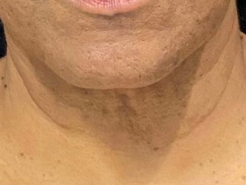 PDO thread Neck lift Before