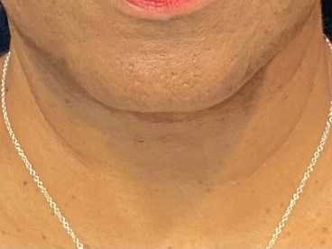 PDO thread Neck lift After
