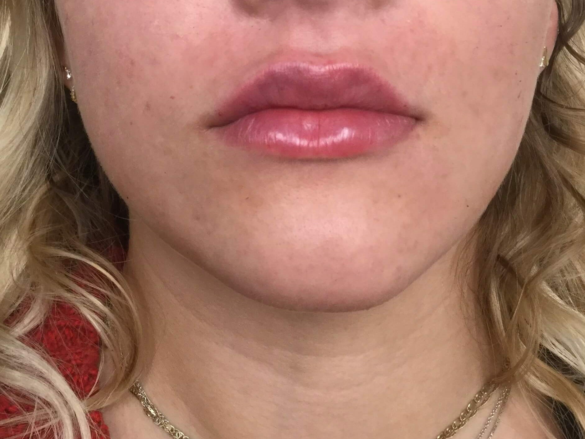 Juvederm Ultra Lips After