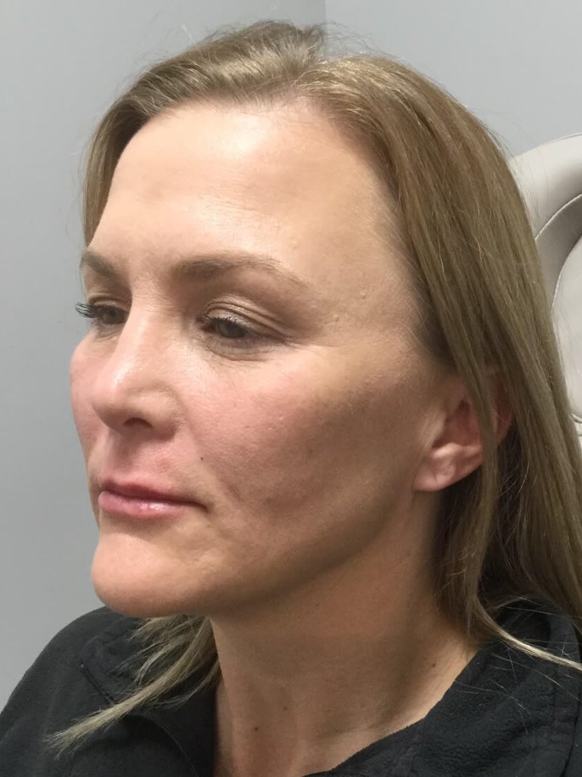 Juvederm Face & Lip Fillers After