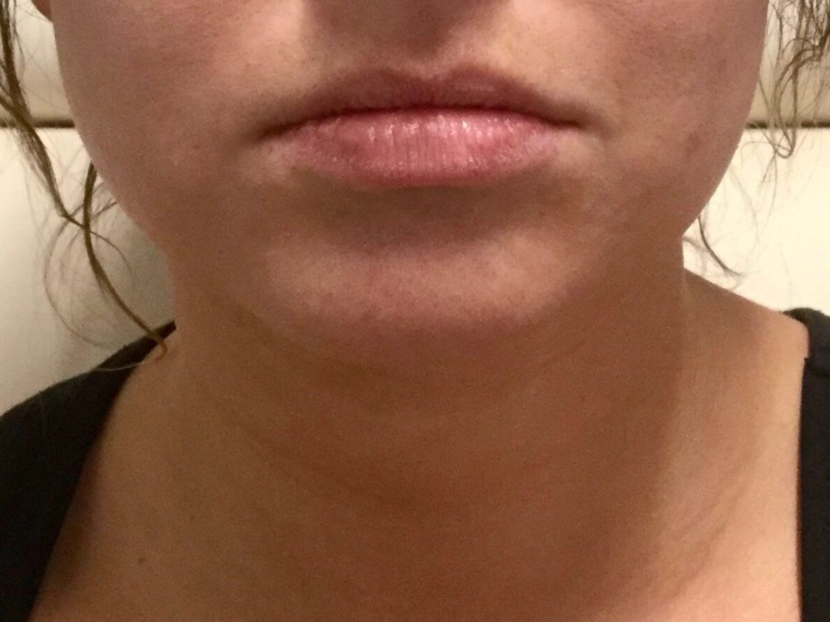 Juvederm Vollure lip fillers Before