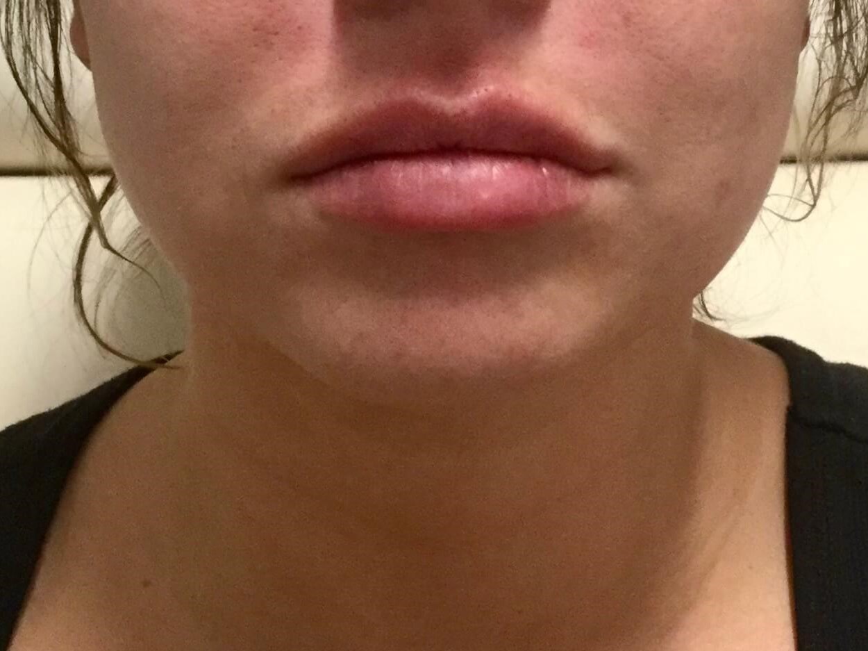 Juvederm Vollure lip fillers After