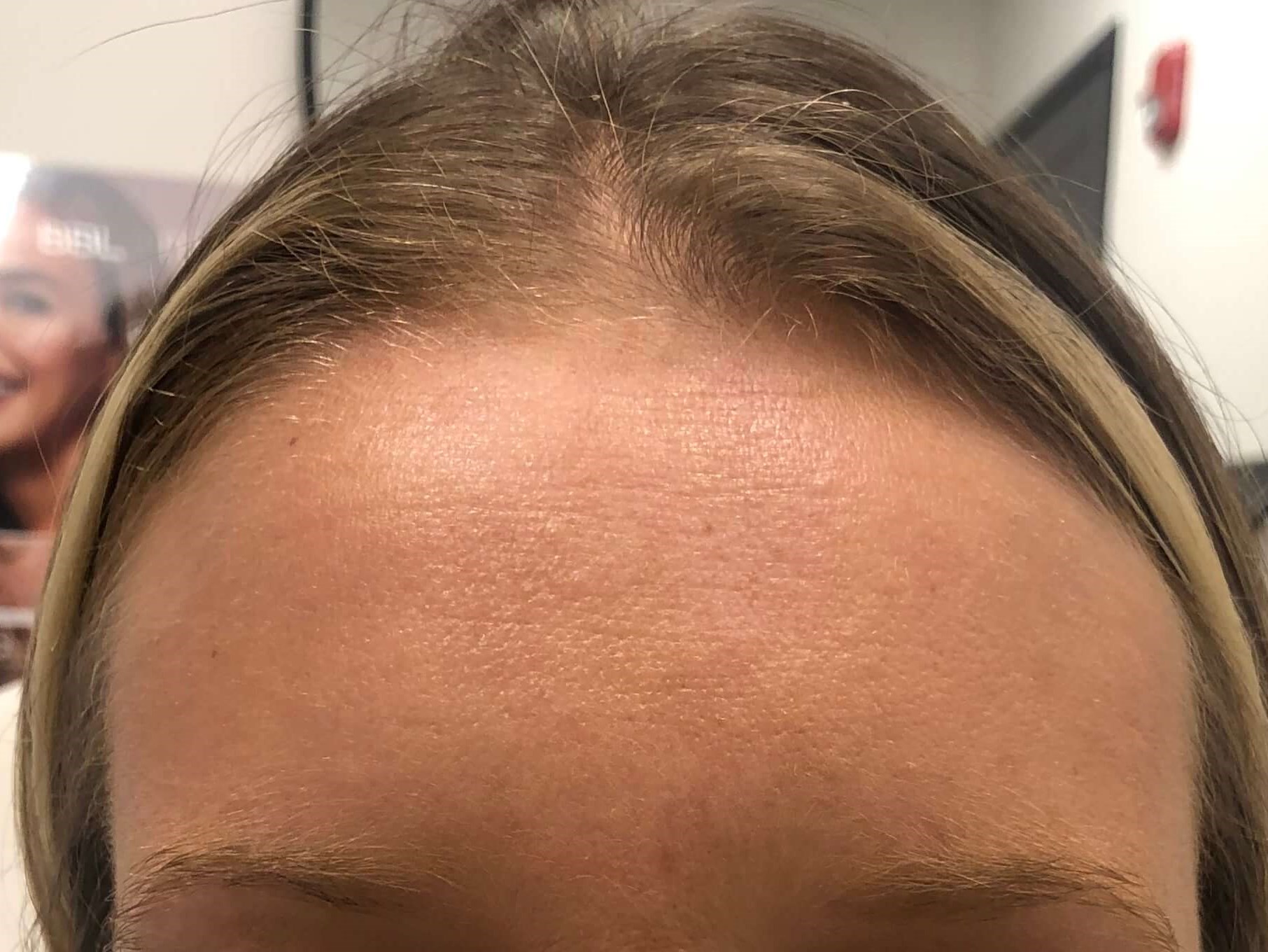 Botox Forehead wrinkles After