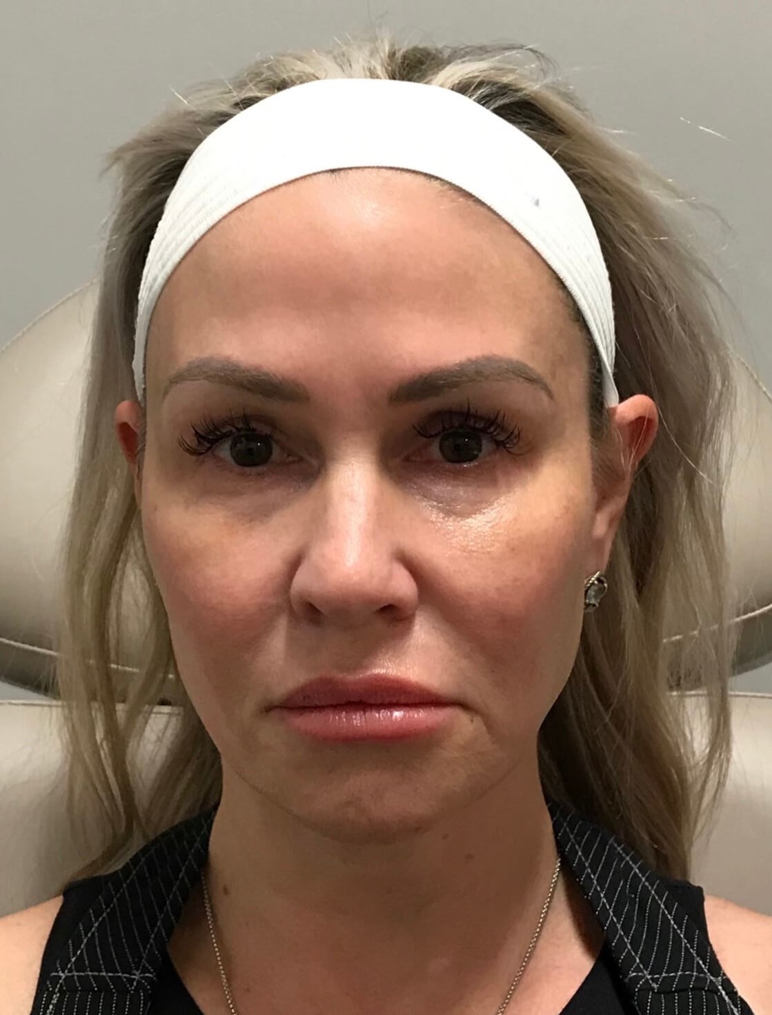 Nonsurgical facial fillers Before