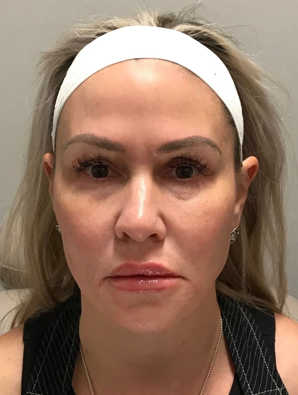 Nonsurgical facial fillers After
