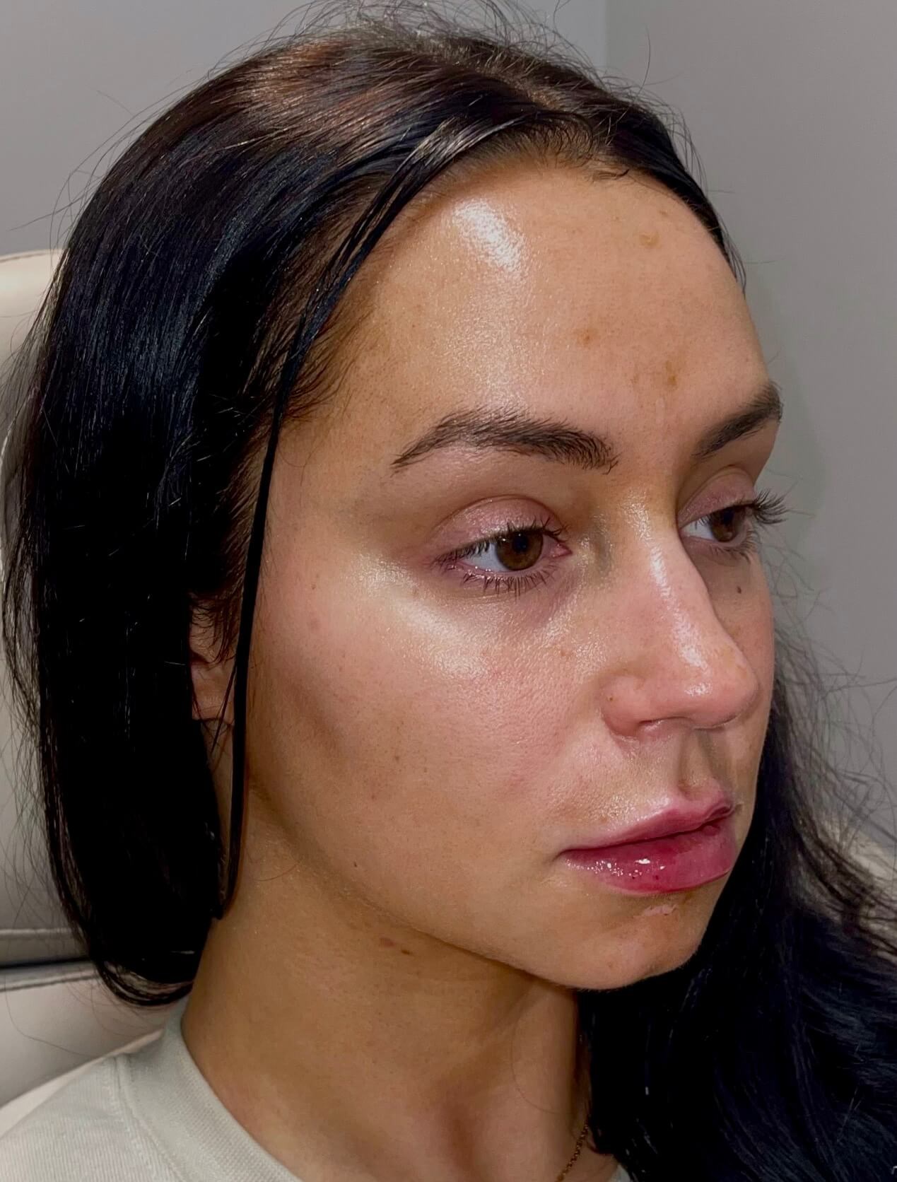 Juvederm Lip Enhancement After