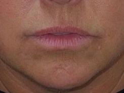 Juvederm Lip Enhancement Before