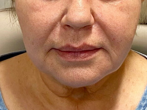 PDO Thread Lower Face Lift Before