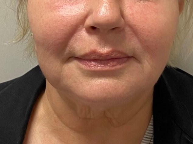 PDO Thread Lower Face Lift After