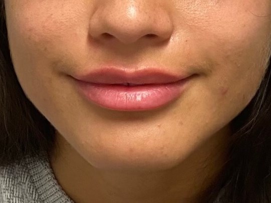 Juvederm lip Enhancement After