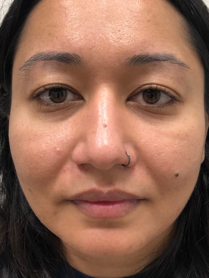 Juvederm Lip Enhancement Before