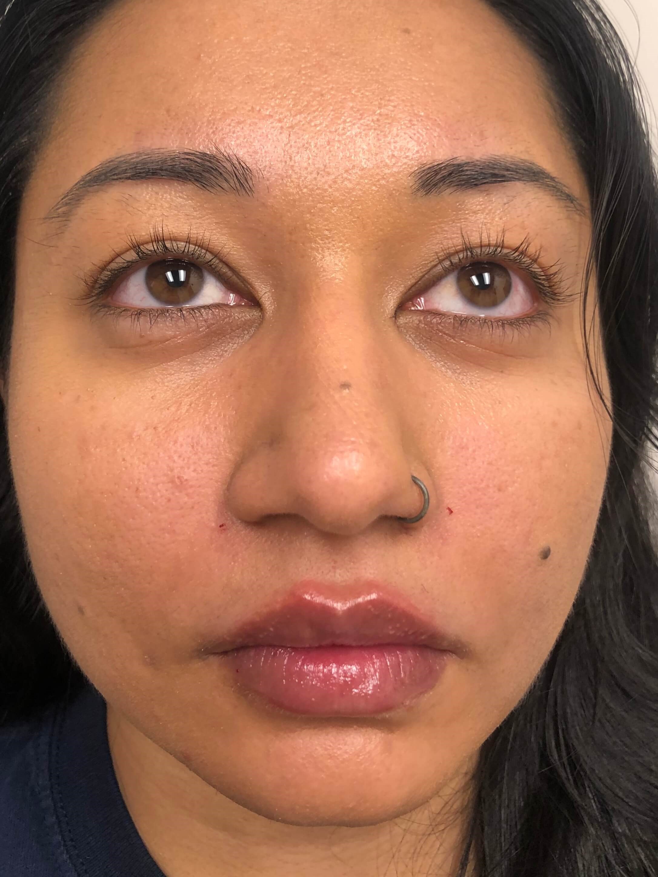 Juvederm Lip Enhancement After