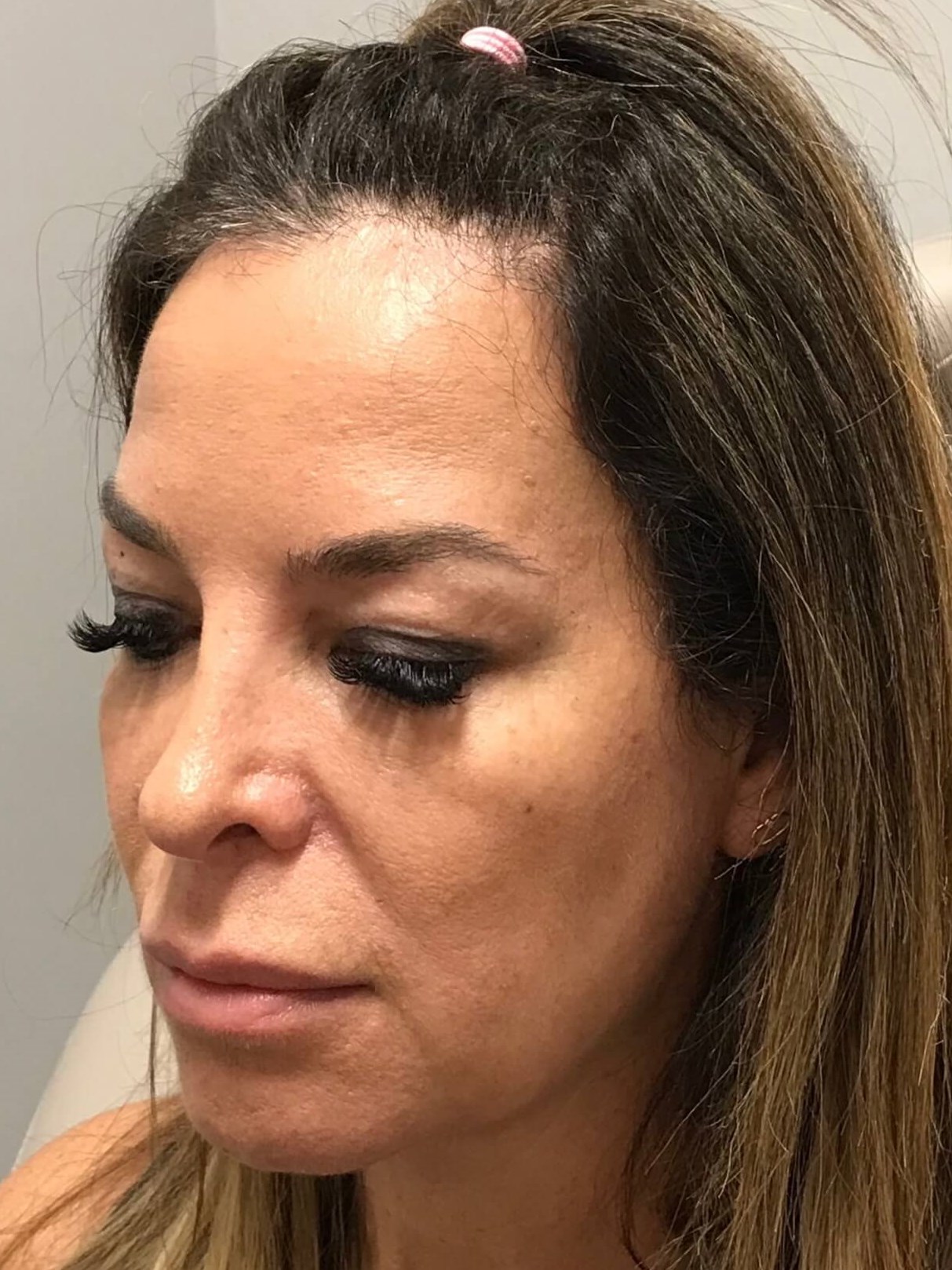 Juvederm Face Rejuvenation Before