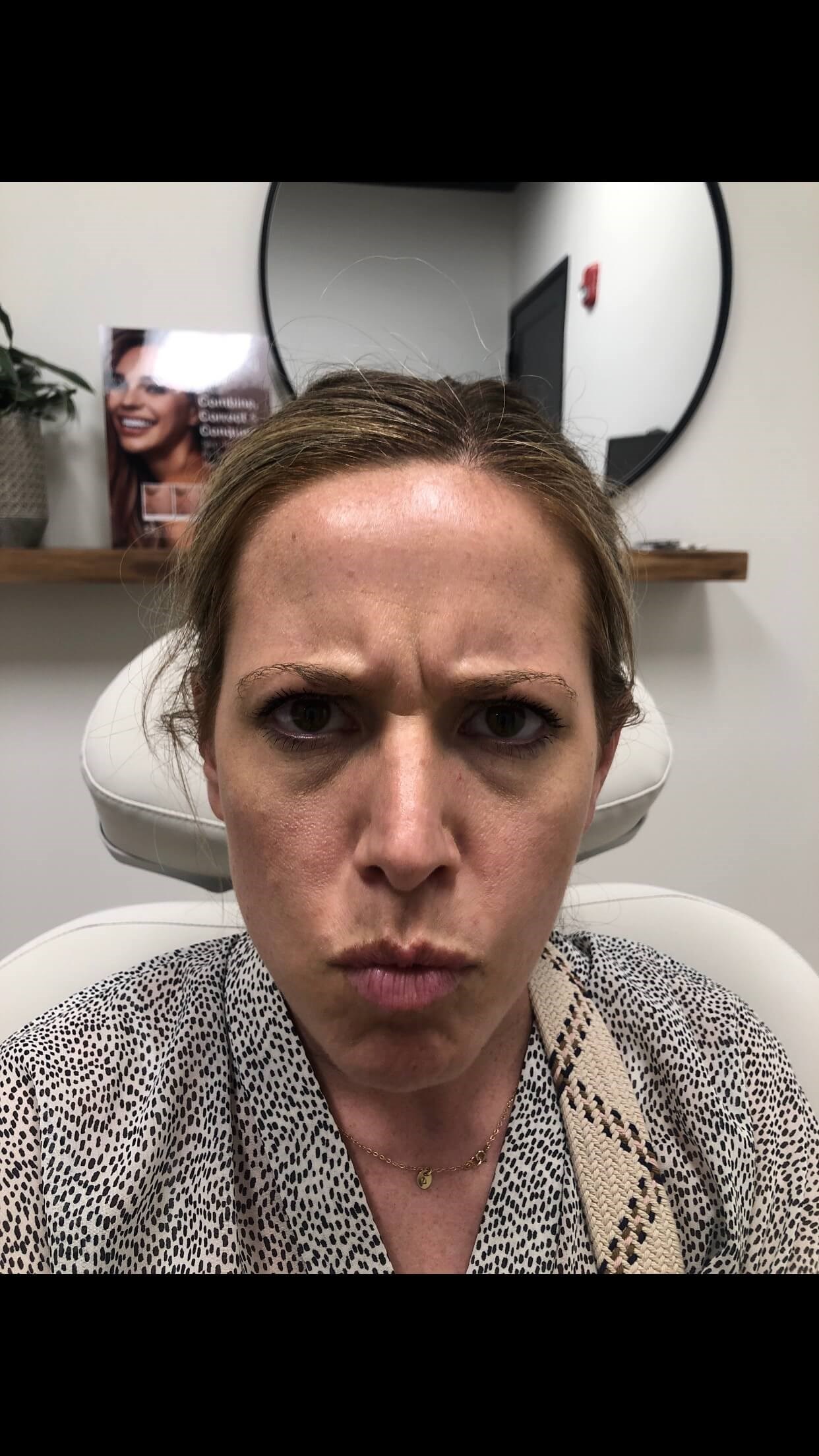 Botox number 11 between brows Before