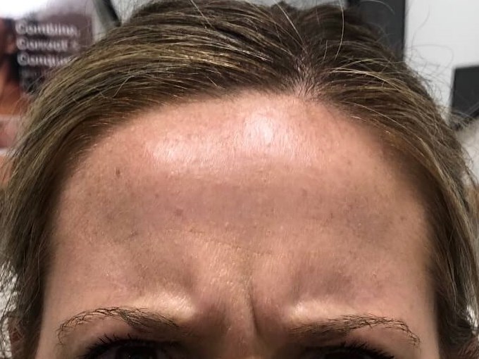 Botox number 11 between brows Before