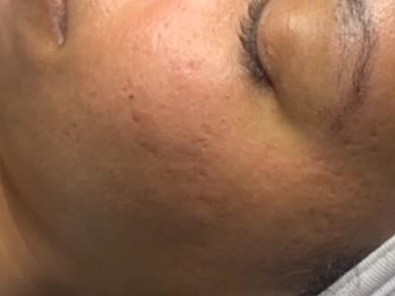 Microneedling Face Before