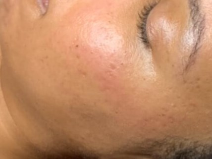 Microneedling Face After