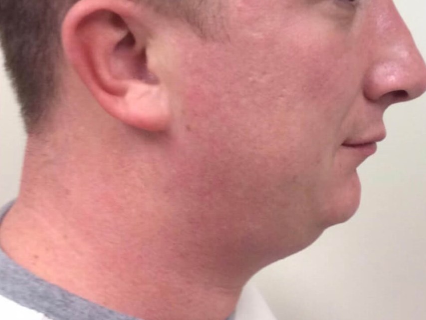 Kybella Submental Fullness Before