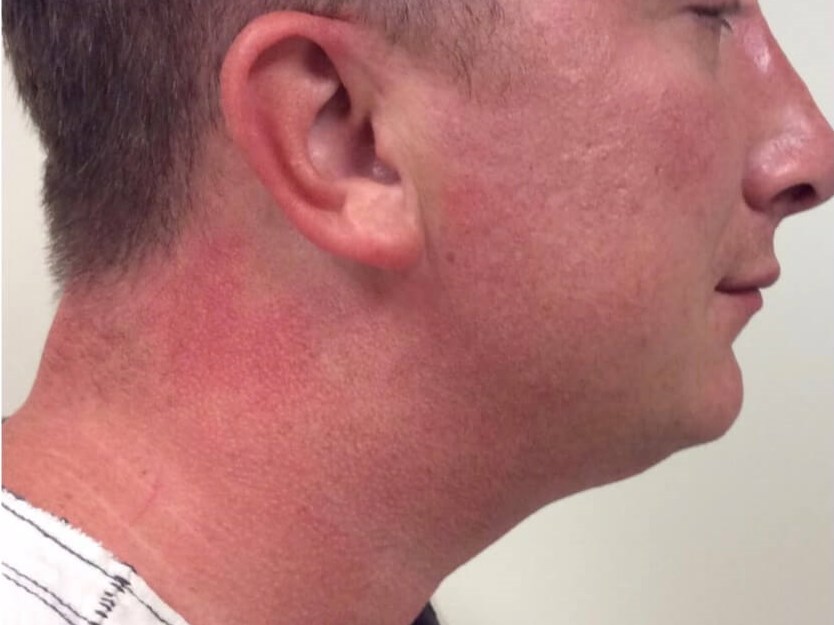 Kybella Submental Fullness After