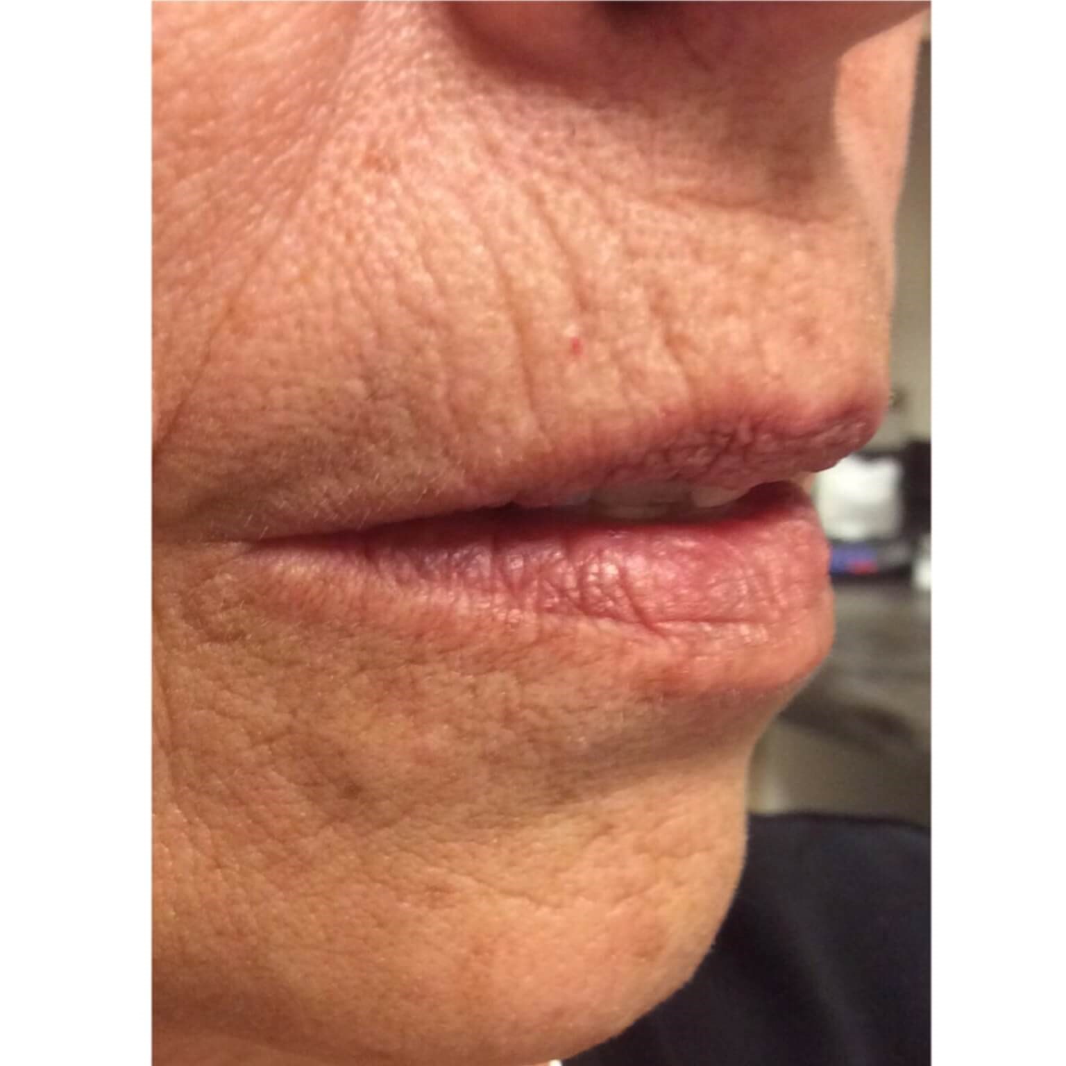 Volbella Lip Lines Before