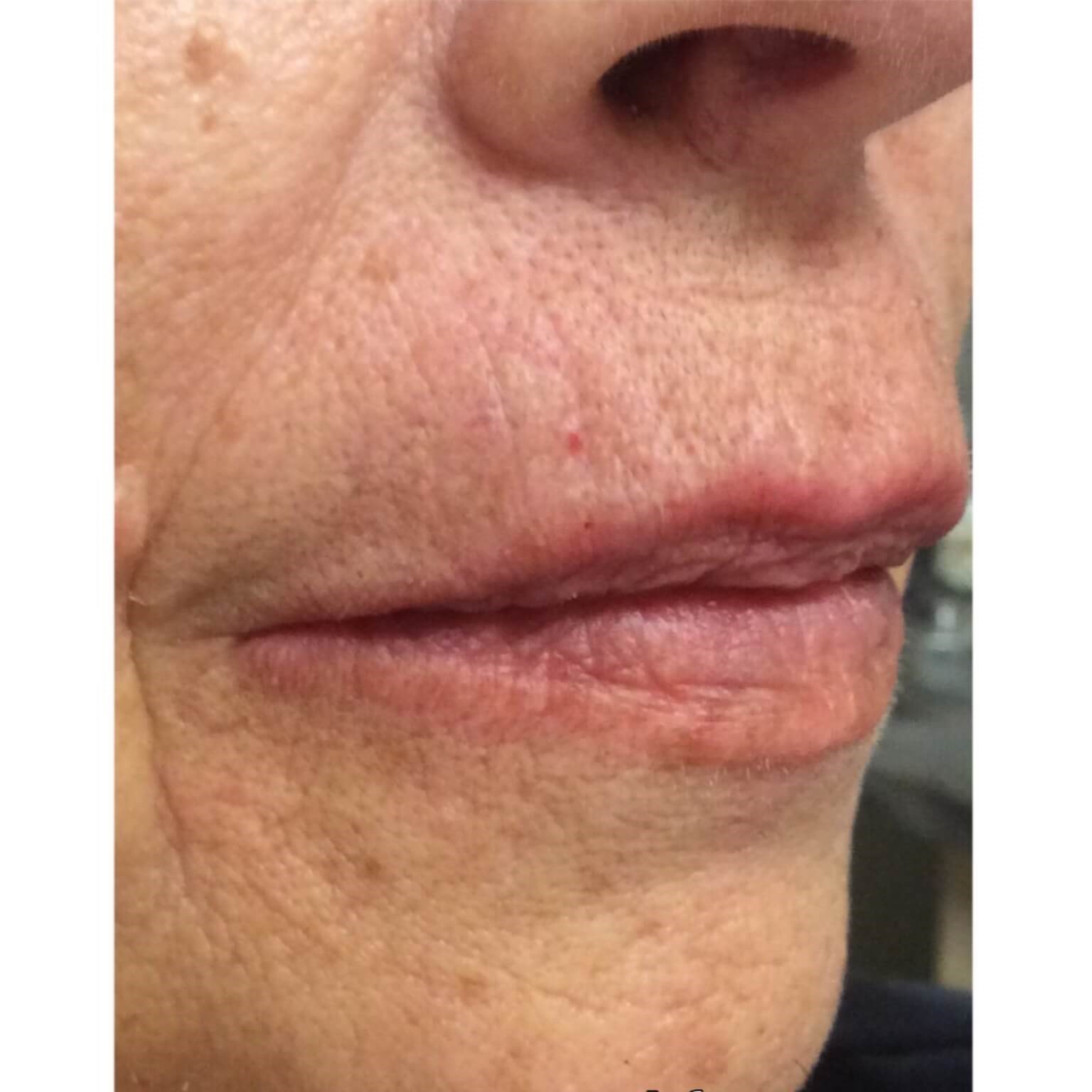 Volbella Lip Lines After