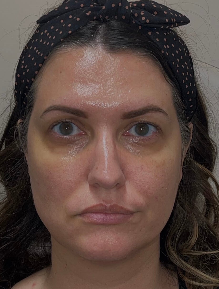 Nonsurgical Face Rejuvenation Before