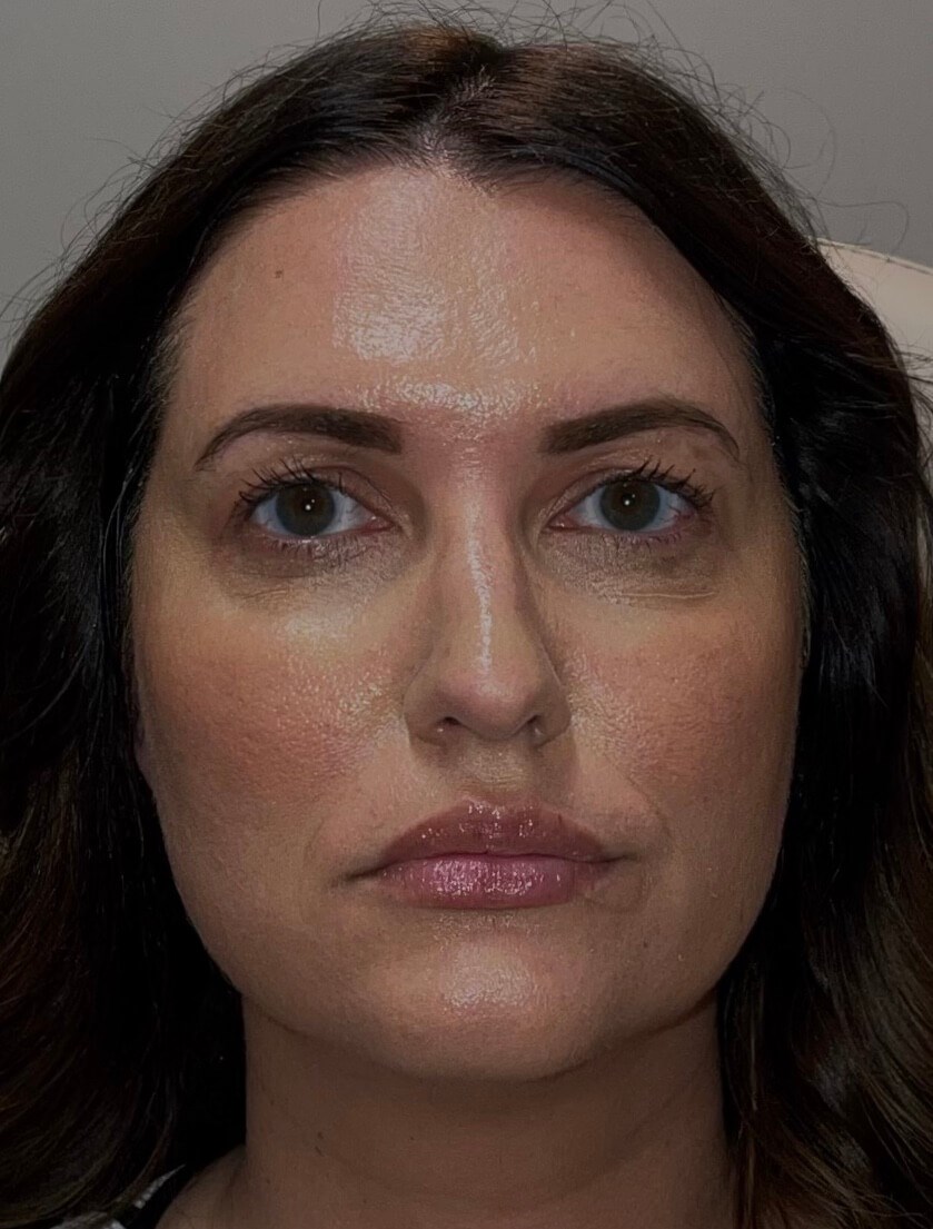 Nonsurgical Face Rejuvenation After
