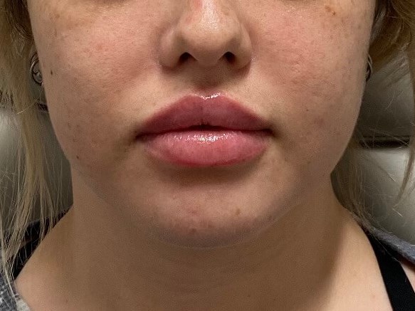 Juvederm Lip Enhancement After