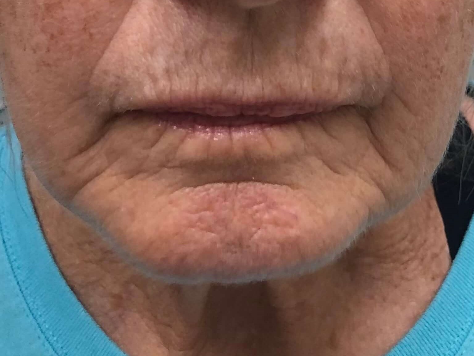 Juvederm Lip Lines Before