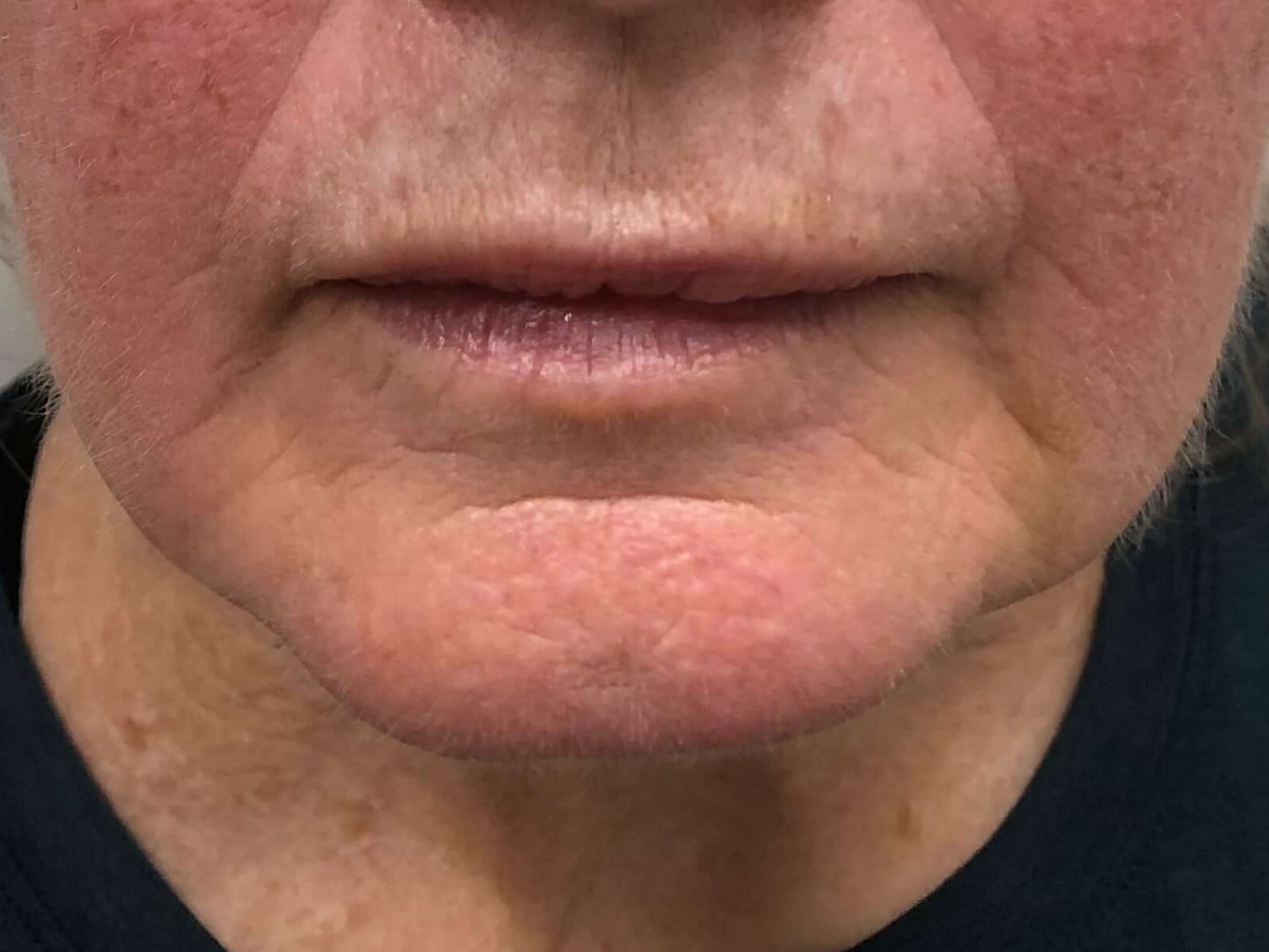 Juvederm Lip Lines After