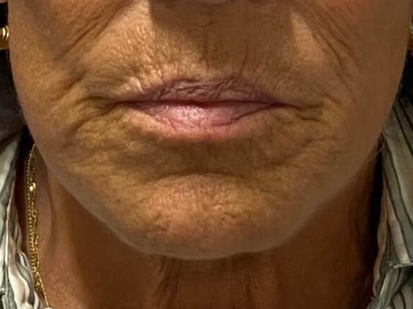 Juvederm Lip Enhancement Before