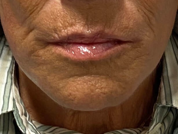 Juvederm Lip Enhancement After