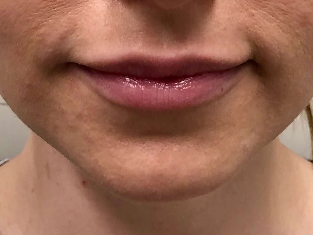 Juvederm Lip Enhancement Before